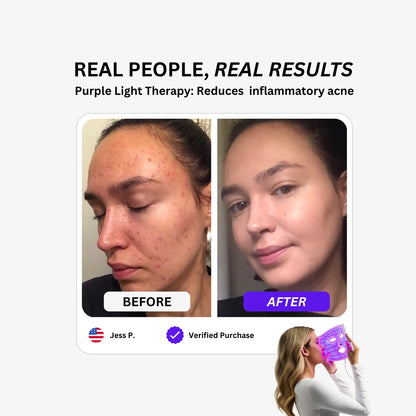 Luxe LED Mask